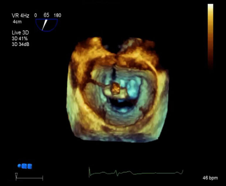 transösophageale echokardiographie 3d kardiologie am schlosspark benrath